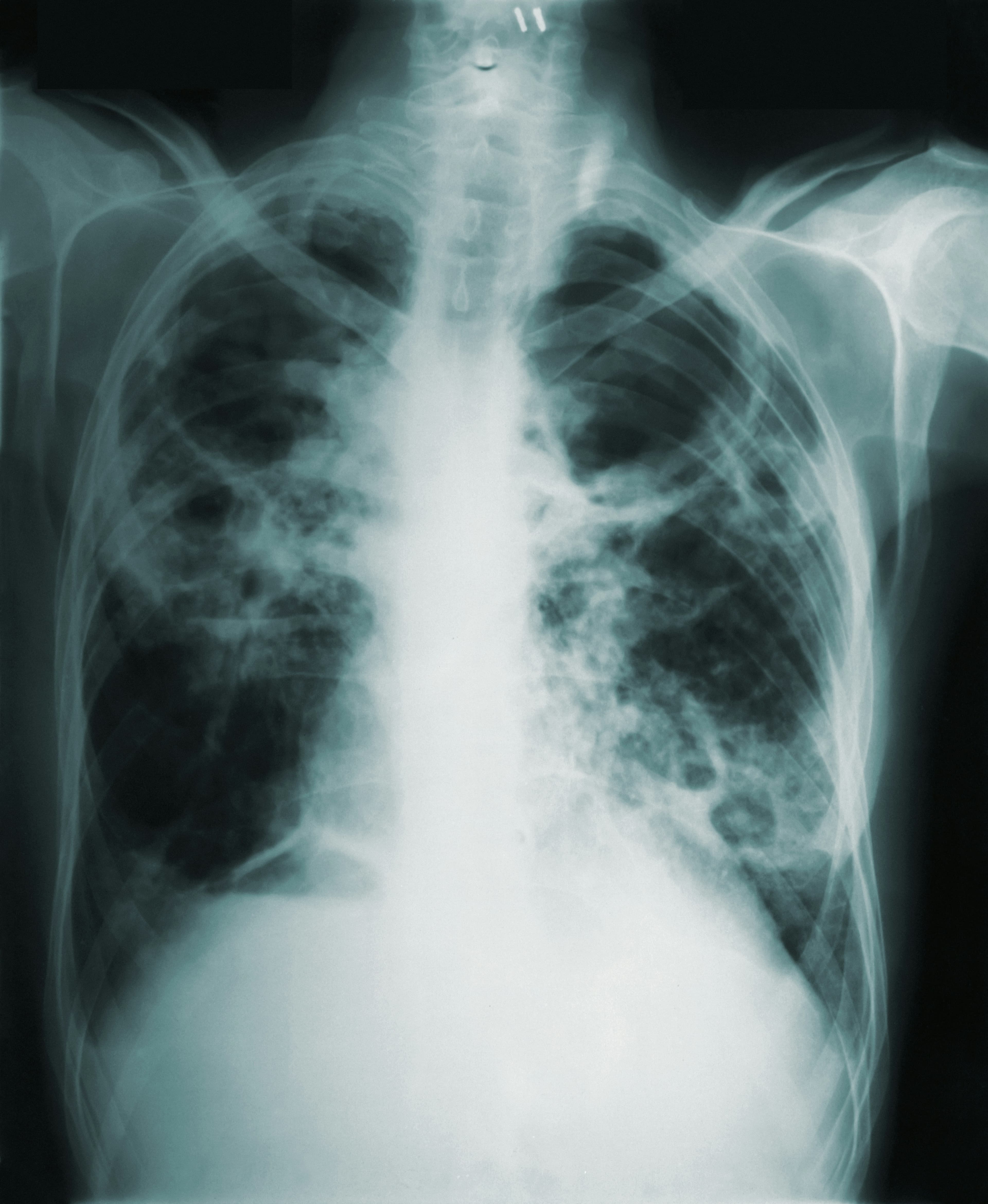 Chest X-ray related to tuberculosis care